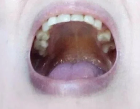 Фото верхней челюсти