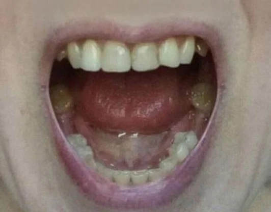 Фото нижней челюсти