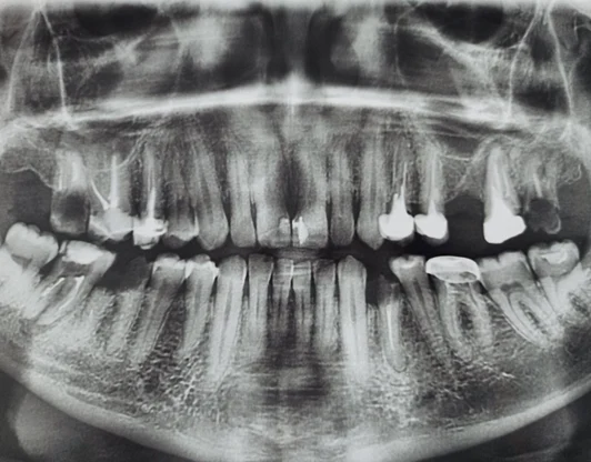 Рентген снимок